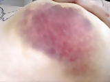 Bruised Tits