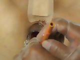Elmers Wife Anal fisting speculum 4